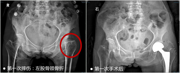 患者第一次手术影像图_副本.jpg