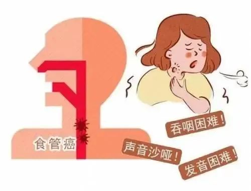 3食道癌.jpg